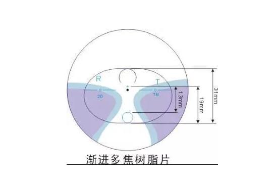 美麗島多焦鏡適合的人群，需要注意的事項(xiàng)